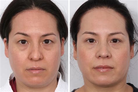 Blepharoplasty Before and After Photos | Dr. Benjamin Paul