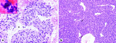 Solitary Fibrous Tumor Hemangiopericytoma A Cohesive Tissue Fragment