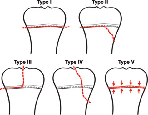 salter harris classification musculoskeletal trauma prognosis physeal