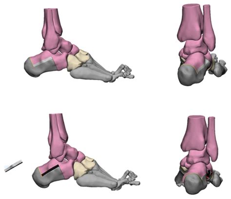 Evaluation and Management of Cavus Foot in Adults: A Narrative Review