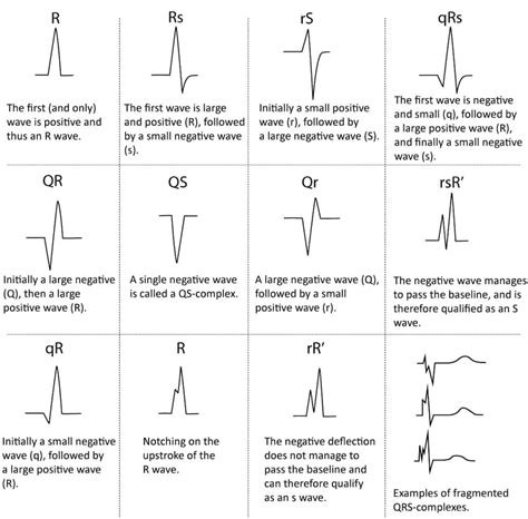 Qrs Interval • Litfl • Ecg Library Basics