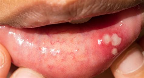 White Spots On Lips Cancer