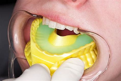 Fluoride Treatment Competitive Dental Hygiene Clinic