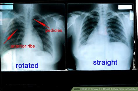 Chest X Ray Rotation