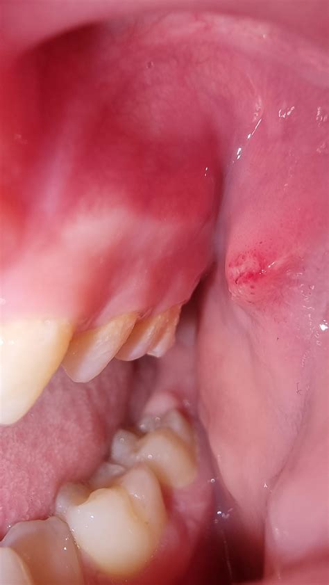 Strange bump/growth on the left cheeck : r/medical_advice