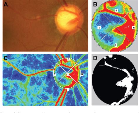 Figure From Clinical Ophthalmology Dovepress Association Between