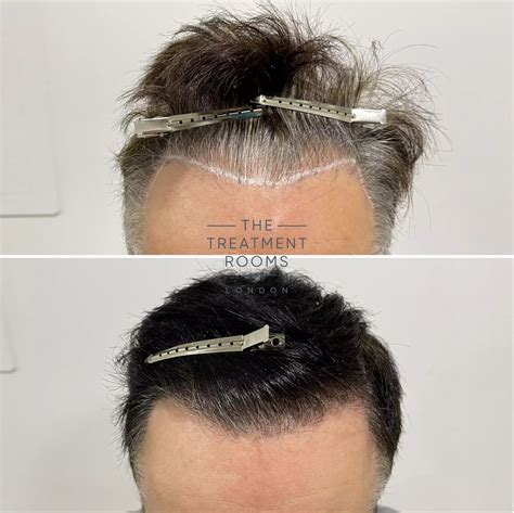 Not Happy With Hair Transplant Results Heres What To Do