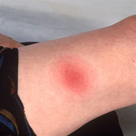 Top 105 Pictures Human Bite Marks Pictures Latest