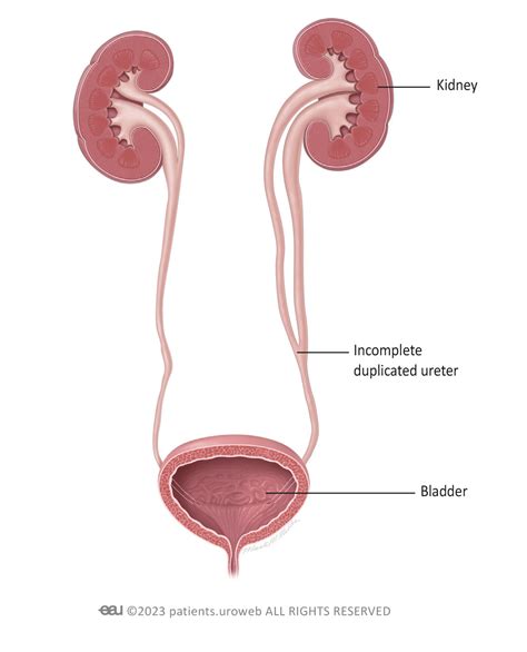 Duplex kidney (ureteral duplication) - Patient Information