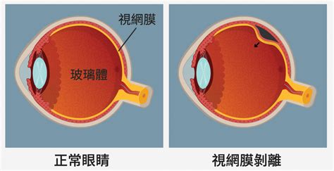 視網膜剝離：若不注意5個徵兆 可致失明 視網膜剝離原因 視網膜剝離檢查 視網膜剝離治療 大紀元