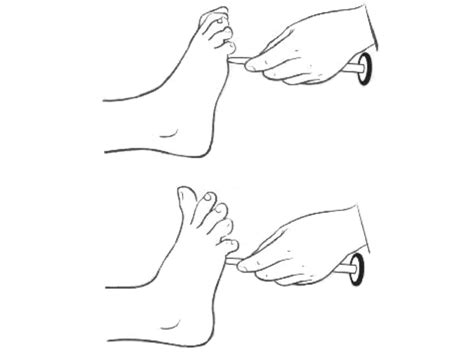 Marteau à reflexe Babinski (3 parties) - Locamed