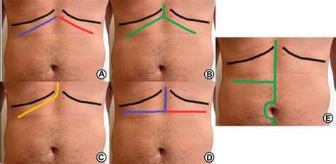 Abdominal Surgical Incisions