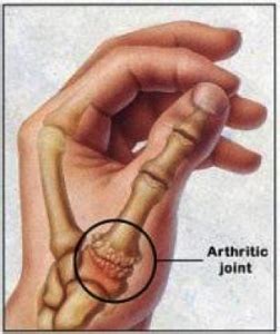 Hand Surgery Associates – CMC Joint