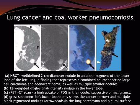 Occupational lung diseases radiology | PPTX