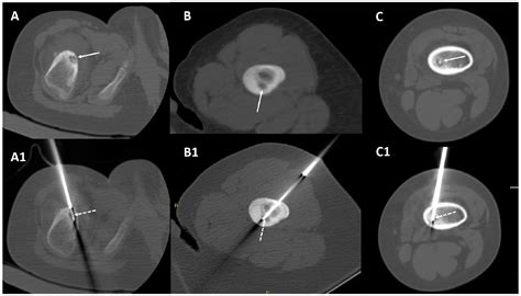 Osteoma Wikidoc