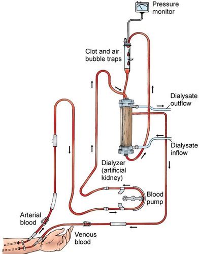 Dialysis Exam 2 Flashcards Quizlet