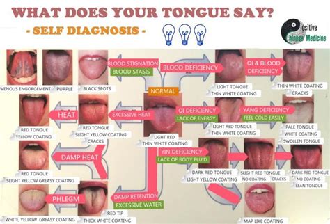 131 best Burning Tongue Syndrome images on Pinterest | Health tips ...