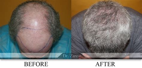 Трансплантация на коса - Резултати д-р Зарев