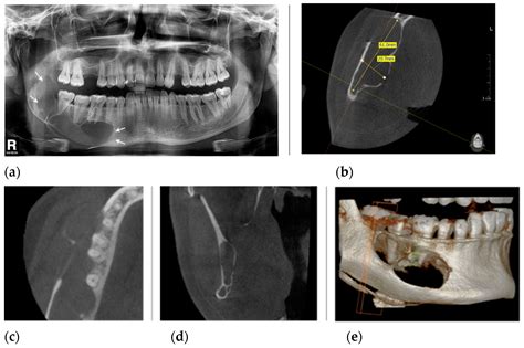 Various Surgical Interventions in Treating Odontogenic Keratocyst: A
