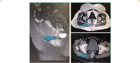 Ct And Mri Showed A Dermoid Cyst With Unilocular Aspect Download