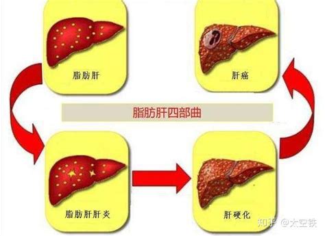 管住嘴迈开腿化解脂肪肝——四千字长文科普脂肪肝 知乎