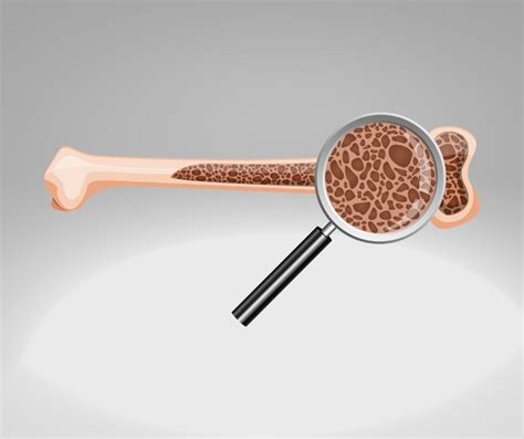 Blood Sugar and Bone Health - Sundrops
