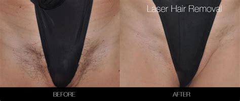 Bikini Brazilian Laser Hair Removal Before After Gallery