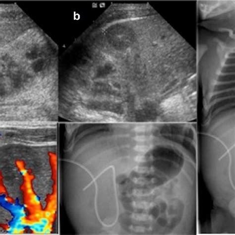 US Study Of The Liver Longitudinal And Transverse Scan Along The