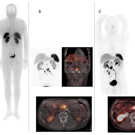 Comparison Between Somatostatin Receptor Functional Images In A Patient