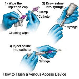 How to Care for your Implanted Venous Access Port - What You Need to Know