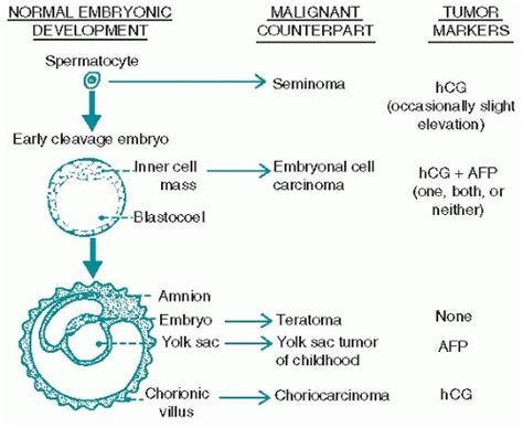 Testicular Cancer Oncohema Key