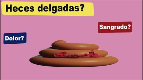 Estenosis Anal Heces Delgadas Dolor Al Evacuar Sangre En Heces YouTube