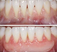 How Long Does A Gum Graft Last Anderson Periodontal Wellness