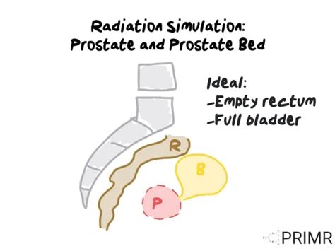 Primr Prostate Cancer Radiation Simulation Procedure Patient