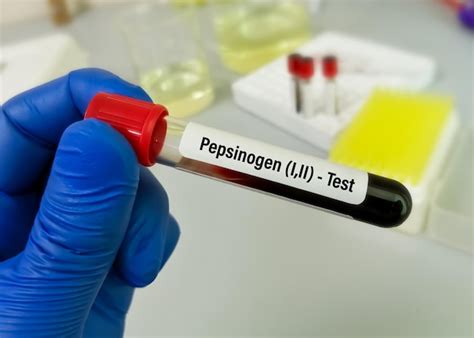 premium photo pepsinogen   ii   diagnosis  early