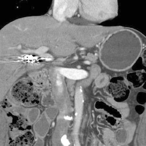 Percutaneous Transhepatic Biliary Drainage Cholangiogram Revealed