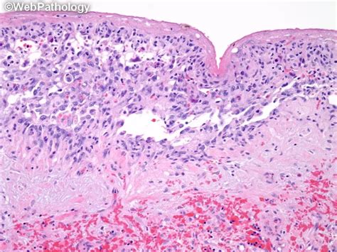 Cardiac Angiosarcoma : Treatment