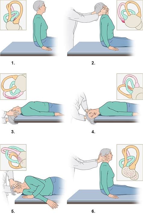 Epley Maneuver Patient Handout Left Ear