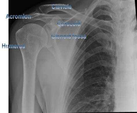 Upper Limb Imaging Anatomy Flashcards Quizlet