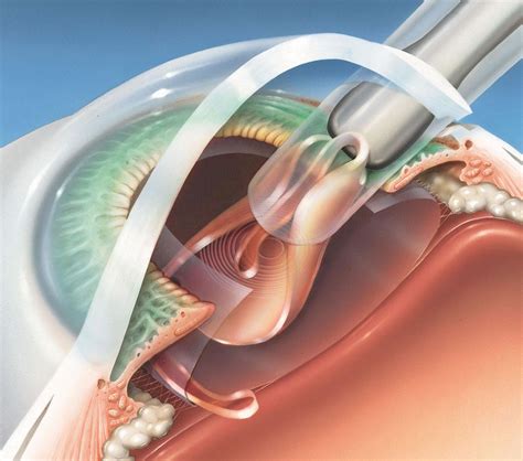 Latest Cataract Surgery Procedures