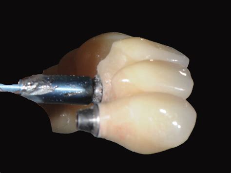 Interim Restoration As Modified By Treating Dentist For Ideal Emergence