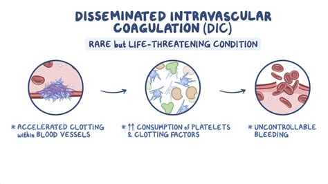 Disseminated Intravascular Coagulation Dic Nursing Osmosis Video