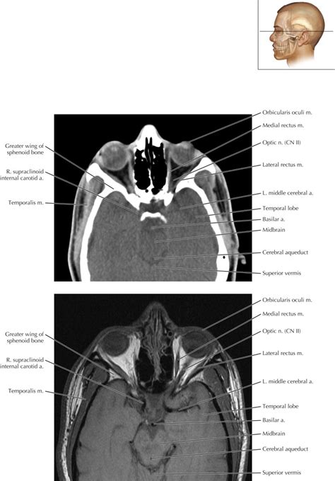 Mandible And Muscles Of Mastication Radiology Key