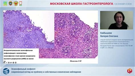 Кайбышева В.О. Эозинофильный эзофагит: современный взгляд на проблему и ...