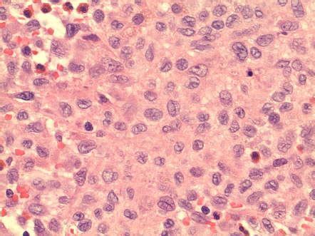 Langerhans Cell Histiocytosis Image Radiopaedia Org