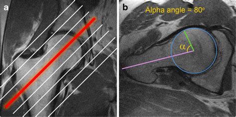 Alpha Angle Femoroacetabular Impingement Pacs