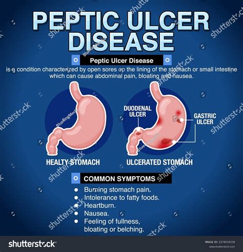 Peptic Ulcer Disease Explained Infographic Illustration Stock Vector Royalty Free 2274019339