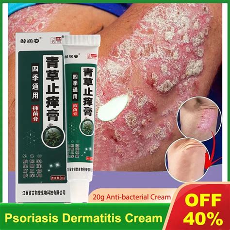 Crema Antibacteriana Herbal De G Crema Para Psoriasis Alivio De La