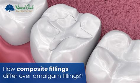 How Composite Fillings Differ Over Amalgam Fillings