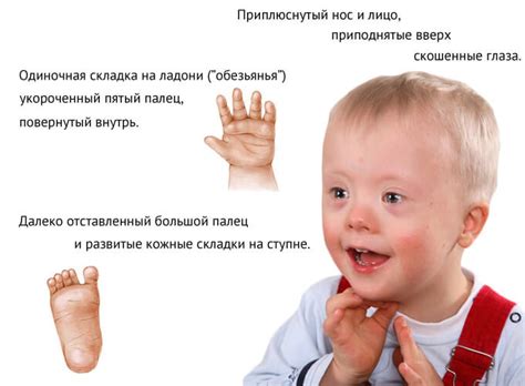 Синдром Дауна: причини, ознаки та супутні патології — Бережіть здоров'я!